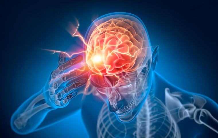 Može li moždani udar da prođe bez simptoma? Doktor objašnjava najčešće nedoumice o šlogu