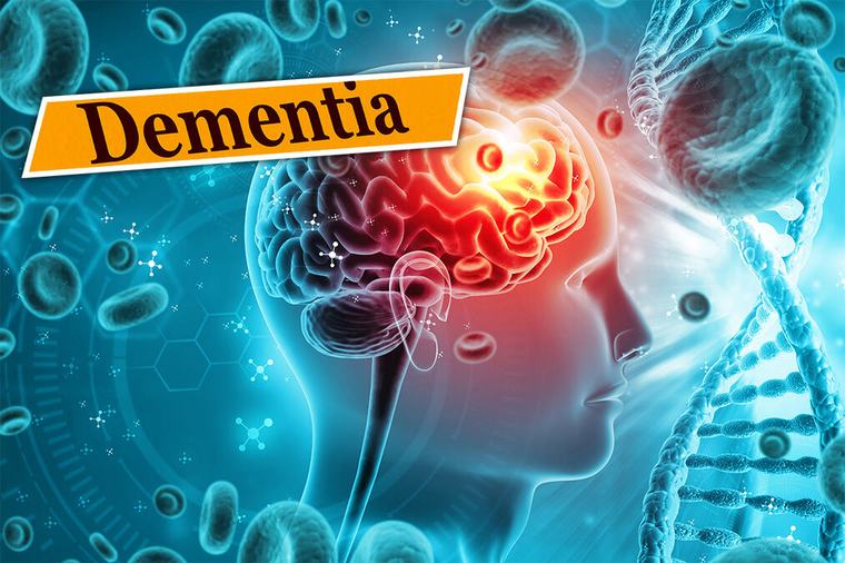 Da li tihi moždani udari mogu izazvati demenciju? Stručnjaci otkrivaju kako nastaje bolest