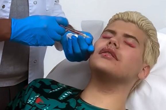 NAKON IZLASKA IZ ELITE 10 MENJA POL Uroš Stanić otišao na remont: Uvećao usne i jagodice, pa pozirao u ordinaciji (Foto)